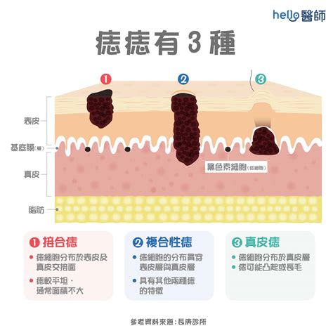 痣多的原因|痣形成的原因？痣長毛、痣變多變大是痣病變？5招判。